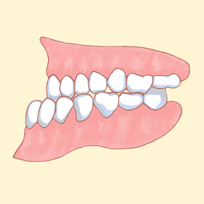 反対咬合（受け口）